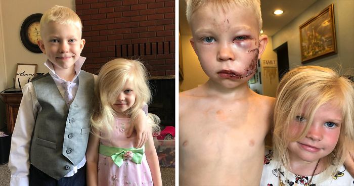 6-Years Old Brother Saves Life of Sister from The Dog Attack 